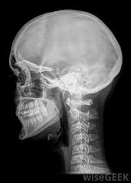 Many people with lung cancer are all too aware that lung cancer can spread. What Is A Head Mass With Pictures