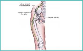 Check spelling or type a new query. Lateral Femoral Cutaneous Nerve Meralgia Paresthetica Medikoe