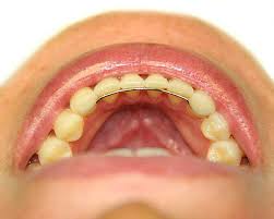 We did not find results for: My Lower Fixed Retainer Came Out What Should I Do Ask An Orthodontist Com