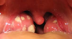 Sintomas Do Cancer De Garganta Por Hpv Cancer Ovarian Cauze Spirituale