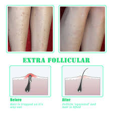 Use acid the cure for ingrown hairs is exfoliation. Amazon Com Tailaimei Exfoliating Brush For Ingrown Hair Treatment To Treat And Prevent Bikini Bumps Razor Bumps Silky Smooth Skin Solution For Men And Women Beauty