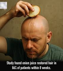 Onion juice has shown surprising potential as a natural remedy for hair  regrowth. A Journal of Dermatology study tested its effects