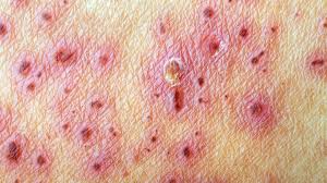 This can be followed by a period of feeling completely healthy. Is It Shingles Virus Or Something Else Everyday Health