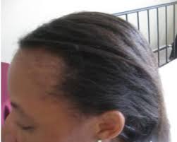 With so many hair problems experienced by men, male pattern baldness is reported to be the most common. Male Pattern Baldness This Pattern Of Hair Loss Can Occur In Women As Well As Men Hair Loss Women Hair Styles Pattern Baldness