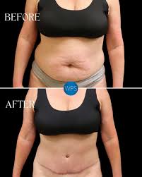 Image result for Liposuction