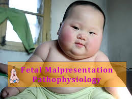 FE TAL MALPRE S E NTATIONFE TAL MALPRE S E NTATION and MALPOS ITION Dr. Iqra  Osman.