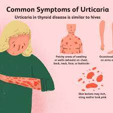 Graves' disease, also known as toxic diffuse goiter, is an autoimmune disease that affects the thyroid. The Link Between Chronic Hives And Thyroid Disease