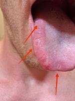 Image result for Puchýře na jazyku