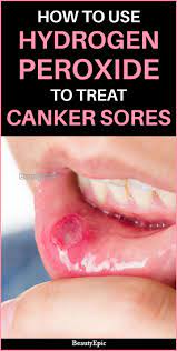 How To Safely Use Hydrogen Peroxide For Canker Sores Canker Sore Canker Sore Remedy Cankers