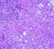 Stomach cancer, also known as gastric cancer, is a fairly uncommon form of cancer in the united states, accounting for 1.5% of all cancers diagnosed each year. Malignant Mesothelioma Stages