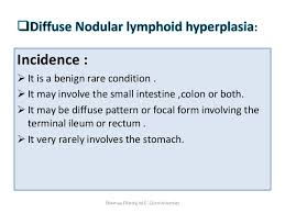 Diffuse Nodular Lymphoid Hyperplasia Dnlh