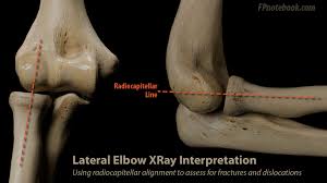 Image result for Elbow XRay