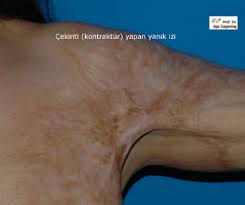 yanik izi tedavisi estetik plastik cerrahi