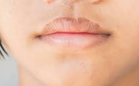 Punca bibir kering dan bengkak. Cek Fakta Bibir Kering Dan Bersisik Jadi Gejala Virus Corona Lifestyle Bisnis Com