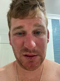 Raccoon eyes and sunburnt noses! Send us your fried pics.