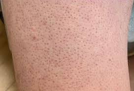 If the hair follicle is still open to the surface. Keratosis Pilaris Wikipedia