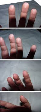 Acide chlorhydrique sur la peau. Brulure Eau De Javel Sur Doigts Et Mains Resolu Forum Libre Sante Forum Sante Doctissimo