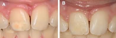 White Enamel Lesions In Children Considering Caries Chronological And Congenital Causes And Their Consequent Care British Dental Journal