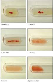 This Is Perfect Grading Agglutination Reactions Medical