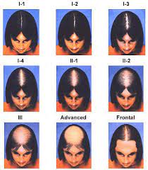 American Hair Loss Association - Women's Hair Loss / Degree Of Hair Loss