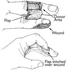 Do you need my help? Fingertip Injuries And Amputations Orthoinfo Aaos