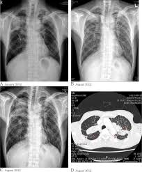 Maybe you would like to learn more about one of these? Chest X Ray A Pneumonitis Or Pulmonary Tuberculosis In Both Upper Download Scientific Diagram