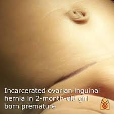 Image result for Inguinal hernia child