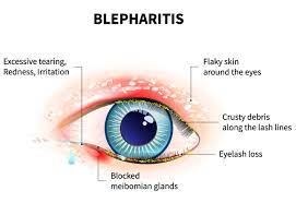 Staphylococcal blepharitis is a more severe condition which may start in childhood and continue through adulthood.8 it is commonly recurrent and it requires special medical care. Understanding Blepharitis Stoney Creek Eye Care