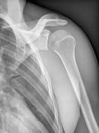Image result for Shoulder XRay