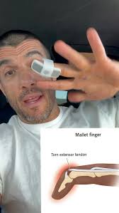 If you’re squeamish you may not wanna watch. I wish I had a better story of  how this happened. , What is the stupidest injury you’ve ever sustained?