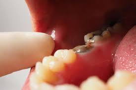 Image result for Periodontal Abscess