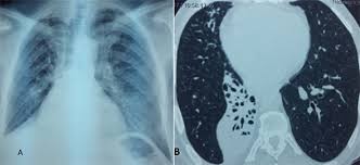 Image result for Broncholithiasis