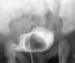 Image result for Voiding Cystourethrogram