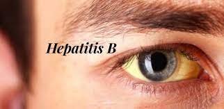 Mata dan kulit menjadi kuning. Simptom Hepatitis B Dan Bagaimana Boleh Dijangkiti