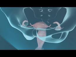 Health Literacy Video Tubal Ligation Surgery Health Literacy Healthcare Nurses Hospital Health