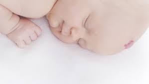 Blutschwamme Hamangiome Ein Betablocker Furs Baby