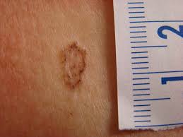 It's not commonly used to diagnose melanoma. Upper Chest Wall Lesion In A Middle Aged Woman Hcplive