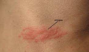 Se caracterizează prin durere și apariția unei benzi eruptive ce se întinde pe o singură parte a corpului. Zona Zoster Academia Pacientului