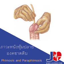 Image result for paraphimosis