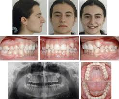 Spring orthodontics is excited to officially open its doors in a few weeks! The Effectiveness Of A Single Osteointegrated Implant Combined With Pendulum Springs For Molar Distalization Dentistrykey