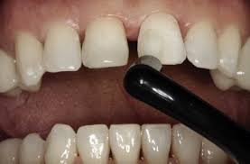 We did not find results for: An Alternative Method For Cementing Laminate Restorations With A Micropulse Toothbrush Sciencedirect