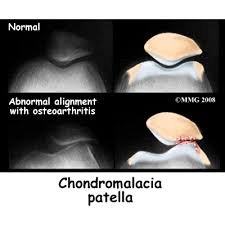 Image result for Patella Mobility Test