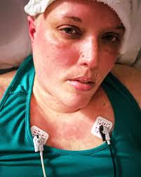 I want the pain to stop. 🔥 This is my face and ear. The burning  erythromelalgia that itches with neuropathic pain nothing can scratch. It  feels like being burned in acid. My