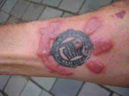 Red Tattoo Ink Reaction Tattoos Tattoo Red Reaction Tattoo Ink Allergy Allergic Reaction To Tattoo Tattoos
