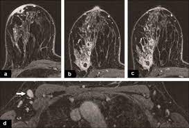 When the cancer grows into the rest of the body through the blood vessels and lymph vessels, breast cancer spreads. Inflammatory Breast Disease The Radiologist S Role Sciencedirect