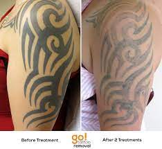 Super Steady Progress On This Half Sleeve Of Tribal After Just 2 Treatments The Client Has Been Putting A Little More Tim Tattoo Removal Tattoos Cover Tattoo