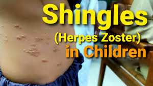 Image result for shingles in children