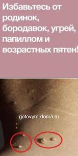как удалить родинку в домашних условиях за 5 минут Smotri Kak Udalit Rodinki Borodavki Ugri I Pigmentnye Pyatna 100 Rezultat Zdorov Ya Oblichchya Kosmetologiya