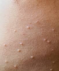 Cryotherapy is an effective treatment option for molluscum contagiosum. Treating Molluscum Contagiosum Current Choices Vs The Future Pipeline The Dermatologist