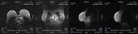 The relationship of free silicone to development or progression of disease is unknown. Mri Diagnosis Of Ruptured Silicone Breast Implants Dr Stuart A Linder